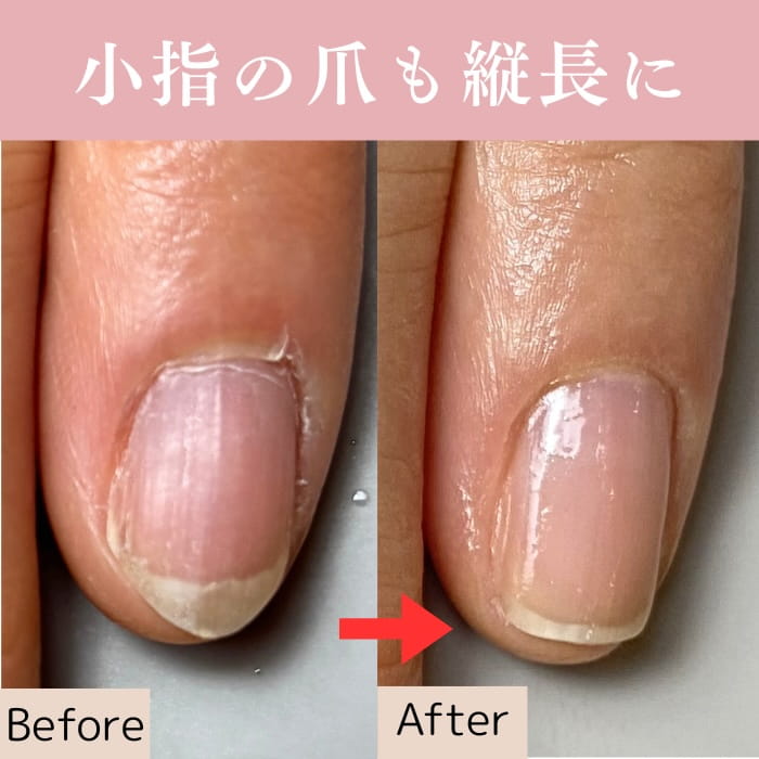 中野ネイルサロン｜爪トラブルネイルケア専門店｜シン｜深爪・割れ爪・欠け爪・二枚爪対応
