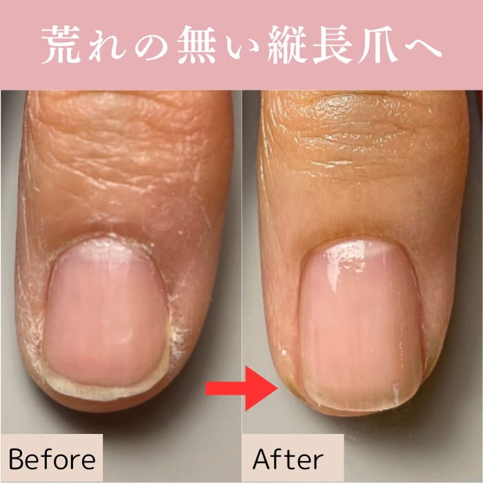 中野ネイルサロン｜爪トラブルネイルケア専門店｜シン｜深爪・割れ爪・欠け爪・二枚爪対応
