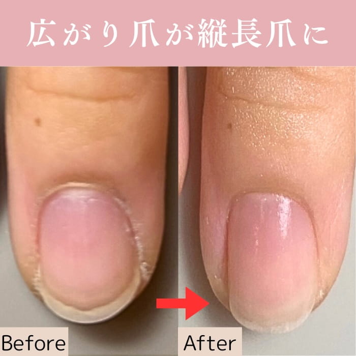 中野ネイルサロン｜爪トラブルネイルケア専門店｜シン｜深爪・割れ爪・欠け爪・二枚爪対応